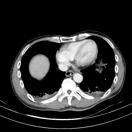 Acute bowel ischemia (Radiopaedia 87695-104114 Axial C+ portal venous phase 9).jpg