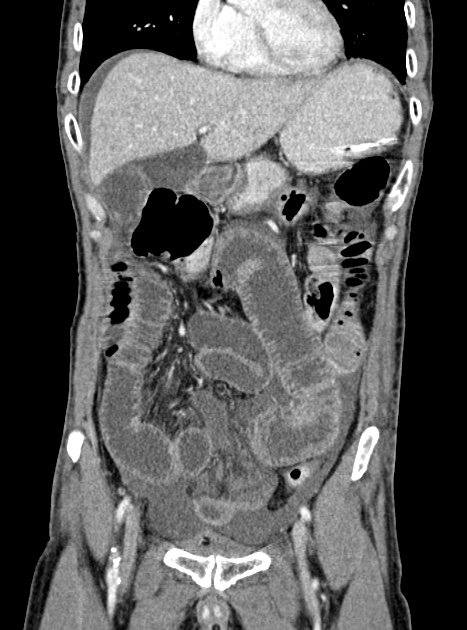 Acute bowel ischemia (Radiopaedia 87695-104114 Coronal C+ portal venous phase 151).jpg