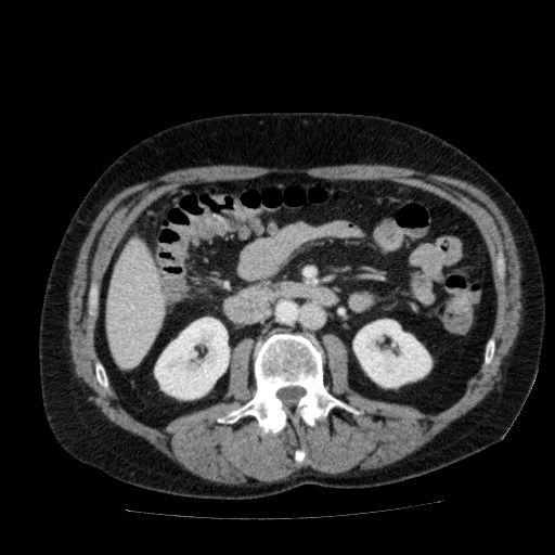 File:Acute cholecystitis and incidental left sided IVC (Radiopaedia 49352-54459 Axial C+ portal venous phase 73).jpg