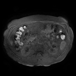 File:Acute cholecystitis complicated by pylephlebitis (Radiopaedia 65782-74915 Axial T1 fat sat 80).jpg