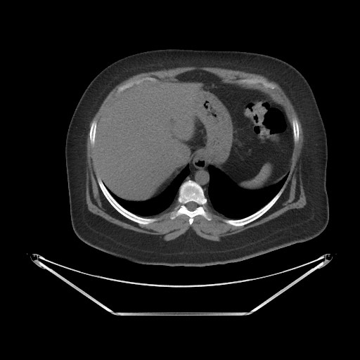 Acute cholecystitis with tensile fundus sign (Radiopaedia 71394-81723 Axial non-contrast 2).jpg