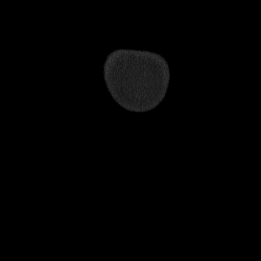 Acute cholecystitis with tensile fundus sign (Radiopaedia 71394-81723 Coronal non-contrast 4).jpg