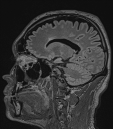 File:Acute disseminated encephalomyelitis (ADEM)- Anti-NMDA receptor encephalitis (Radiopaedia 54920-61201 Sagittal FLAIR 36).png