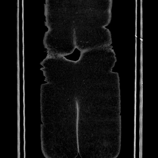 Acute diverticulitis - transverse colon (Radiopaedia 87063-103327 Coronal C+ portal venous phase 161).jpg