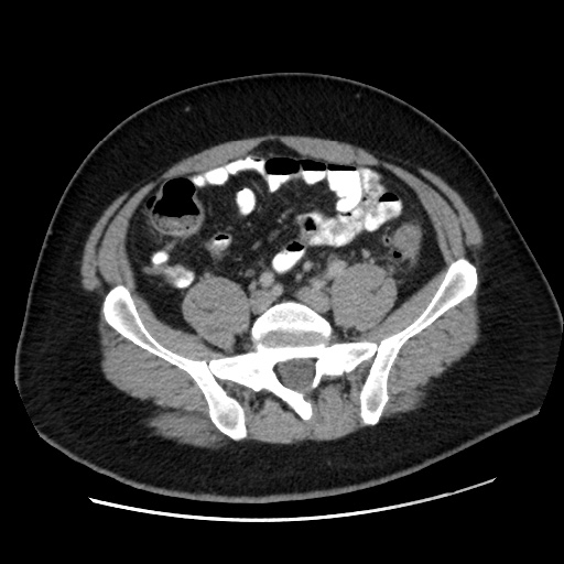 Acute diverticulitis with localized perforation (Radiopaedia 41296-44113 Axial C+ portal venous phase 64).jpg