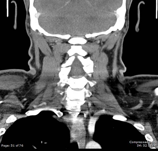 Acute epiglottitis (Radiopaedia 54375-60590 Coronal C+ arterial phase 51).jpg
