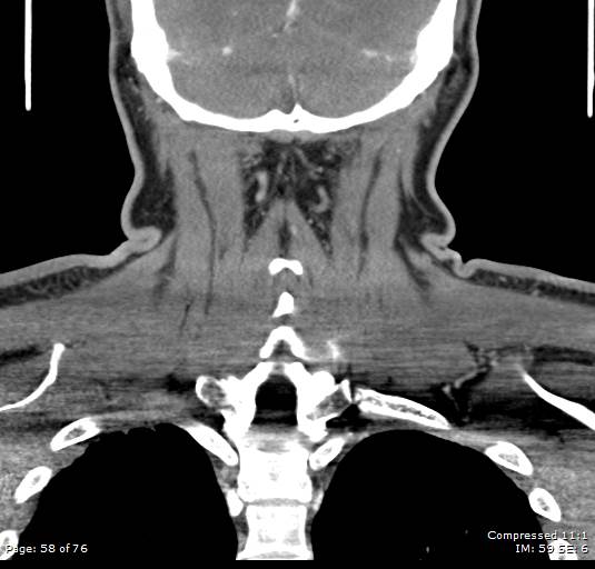 Acute epiglottitis (Radiopaedia 54375-60590 Coronal C+ arterial phase 58).jpg