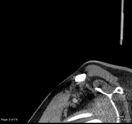 Acute epiglottitis (Radiopaedia 54375-60590 Sagittal C+ arterial phase 3).jpg