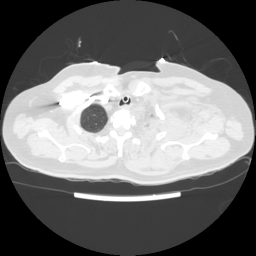 File:Acute heart failure (CT) (Radiopaedia 79835-93075 Axial lung window 3).png