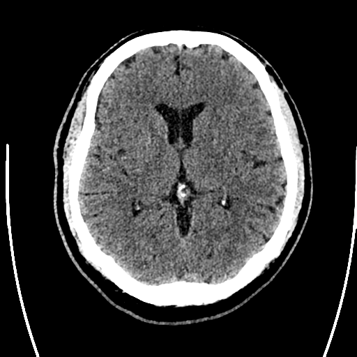 Acute left middle cerebral artery territory ischemic stroke (Radiopaedia 35688-37223 Axial non-contrast 40).png