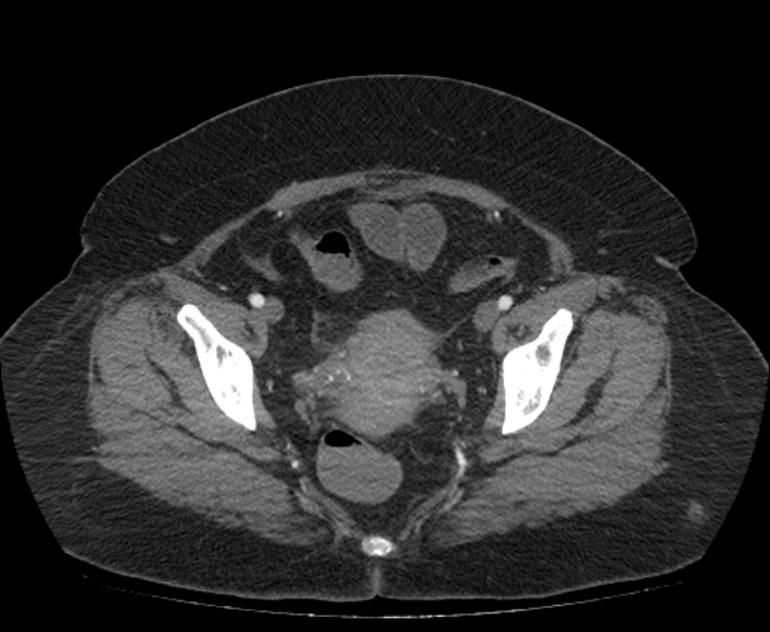 Acute mesenteric ischemia (Radiopaedia 80029-93316 Axial C+ arterial phase 118).jpg