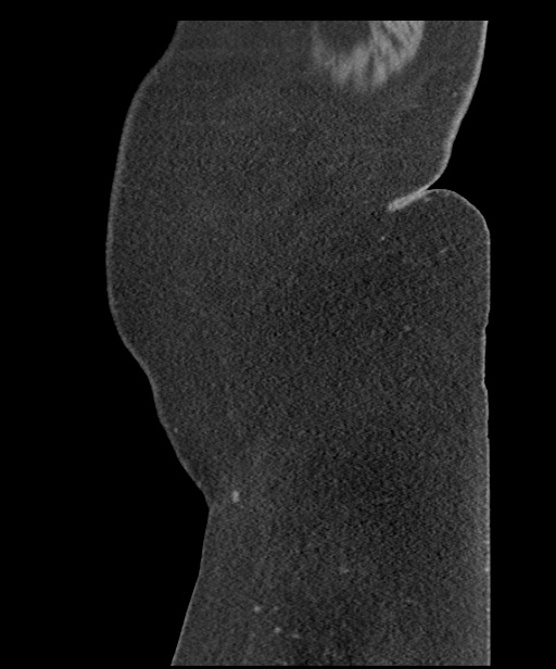 Acute mesenteric venous ischemia (Radiopaedia 46041-50383 Sagittal C+ portal venous phase 121).jpg