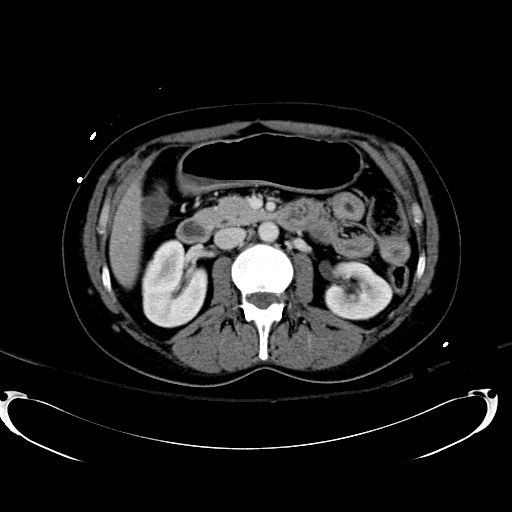 Acute myocardial infarction in CT (Radiopaedia 39947-42415 Axial C+ portal venous phase 53).jpg