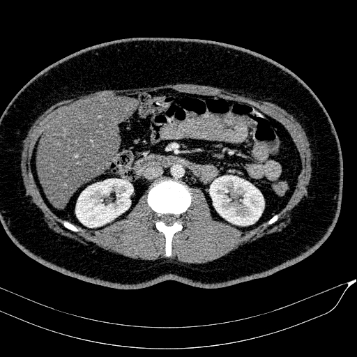 Acute on chronic pancreatitis (Radiopaedia 80902-94423 Axial C+ portal venous phase 83).jpg