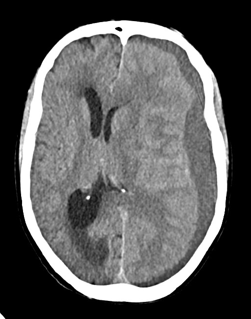 Acute on chronic subdural hematoma (Radiopaedia 74814-85823 Axial non-contrast 47).jpg
