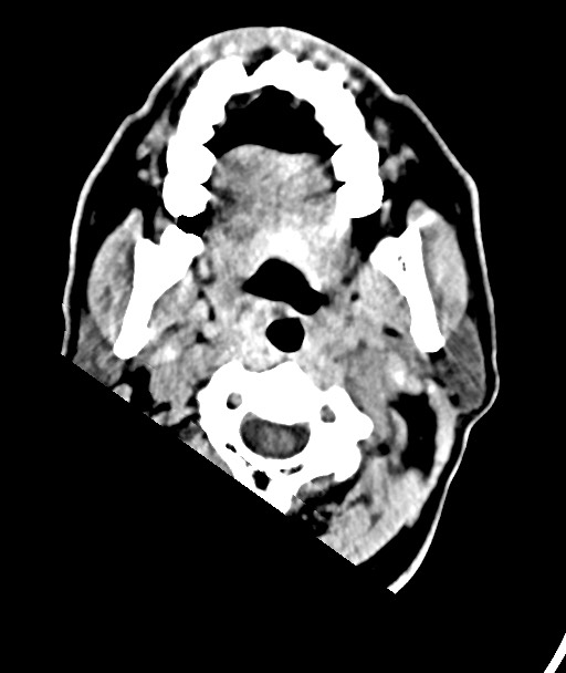 Acute on chronic subdural hematoma (Radiopaedia 78346-90966 Axial non-contrast 3).jpg