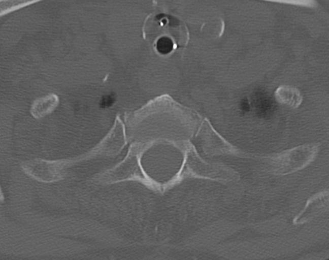 Acute on chronic subdural hematoma and thoracic vertebral injury in a multitrauma patient (Radiopaedia 31698-32619 Axial bone window 56).jpg