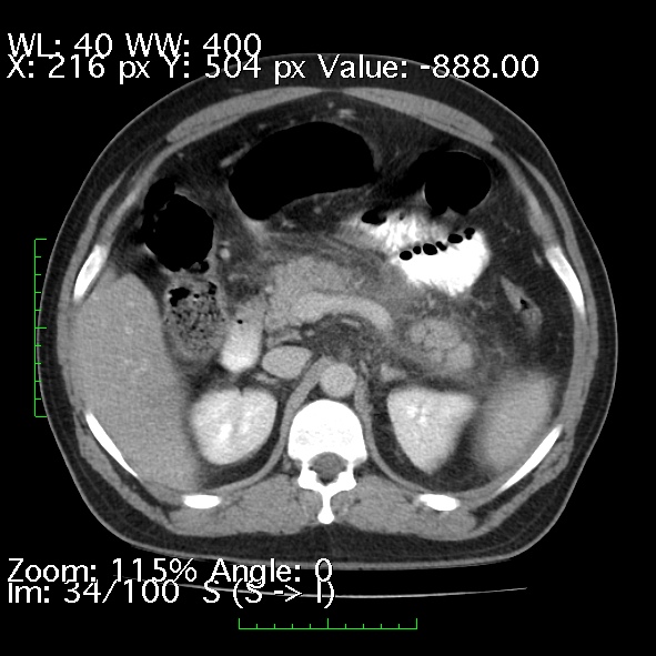 Acute pancreatitis (Radiopaedia 34043-35276 Axial C+ portal venous phase 34).jpg