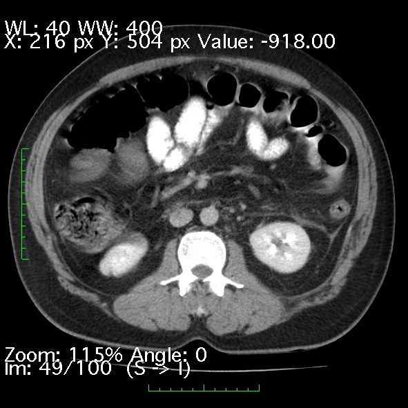 Acute pancreatitis (Radiopaedia 34043-35276 Axial C+ portal venous phase 49).jpg