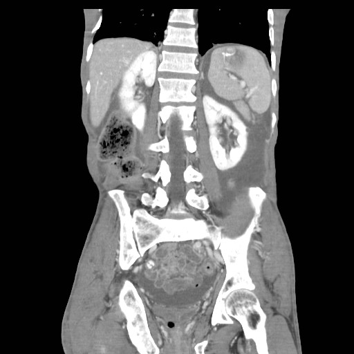 File:Acute pancreatitis (Radiopaedia 50213-55558 Coronal C+ portal venous phase 32).jpg