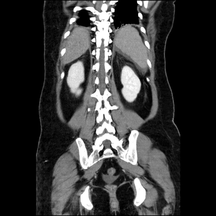 Acute pancreatitis (Radiopaedia 69236-79012 Coronal C+ portal venous phase 25).jpg