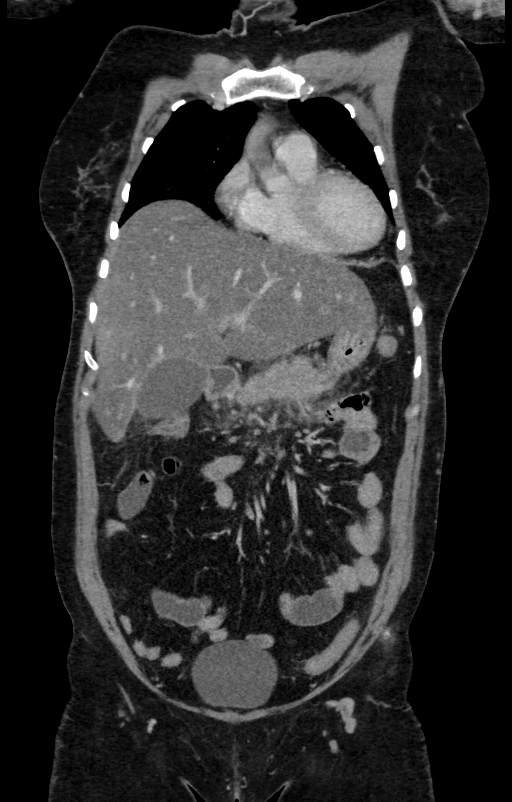 Acute pancreatitis (Radiopaedia 80007-93285 Coronal C+ portal venous phase 37).jpg