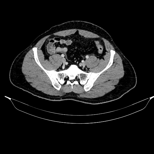 Acute pancreatitis (Radiopaedia 87428-103757 Axial C+ portal venous phase 76).jpg
