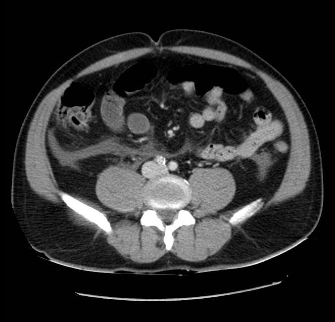 Acute pancreatitis - Balthazar E (Radiopaedia 23080-23110 Axial C+ portal venous phase 44).jpg