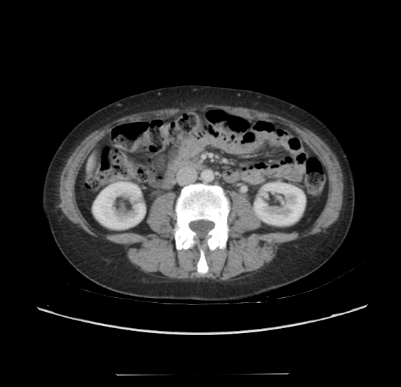 File:Acute pancreatitis - Balthazar E - post ERCP (Radiopaedia 27562-27772 Axial C+ portal venous phase 40).png