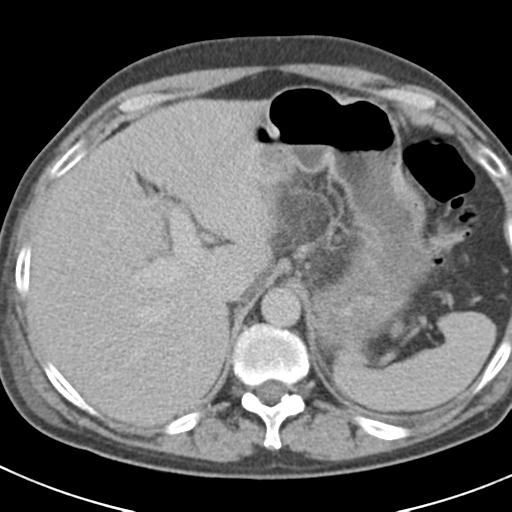 Acute pancreatitis and walled-off necrosis (Radiopaedia 29888-30403 Axial C+ delayed 20).jpg