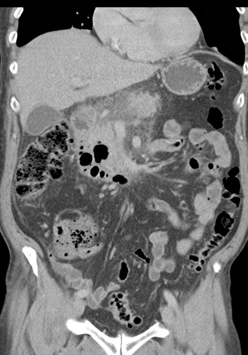 Acute pancreatitis and walled-off necrosis (Radiopaedia 29888-30403 E 24).jpg