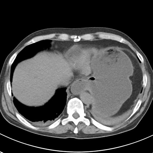 File:Acute pancreatitis and walled-off necrosis (Radiopaedia 29888-30404 Axial non-contrast 8).jpg
