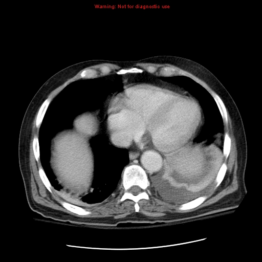 File:Acute pancreatitis with incidental pancreatic lipoma (Radiopaedia 10190-10730 Axial C+ portal venous phase 3).jpg