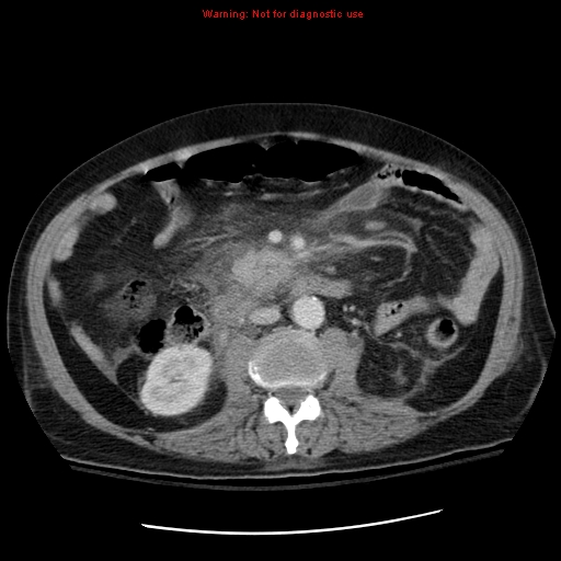 File:Acute pancreatitis with incidental pancreatic lipoma (Radiopaedia 10190-10730 Axial C+ portal venous phase 36).jpg