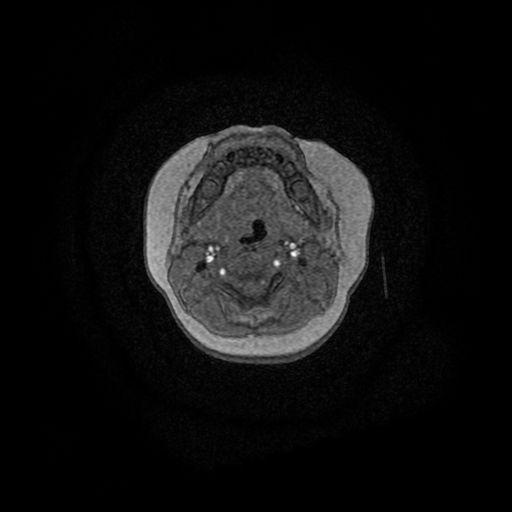 Acute phase of hemiconvulsion-hemiplegia epilepsy syndrome (Radiopaedia 29309-29745 Axial TOF angiography 185).jpg