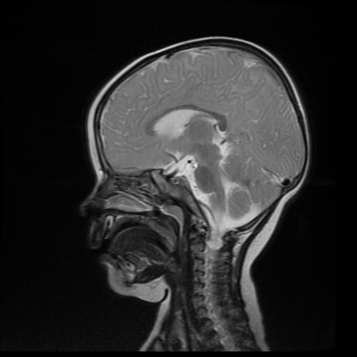 File:Acute phase of hemiconvulsion-hemiplegia epilepsy syndrome (Radiopaedia 29309-29745 Sagittal T2 12).jpg