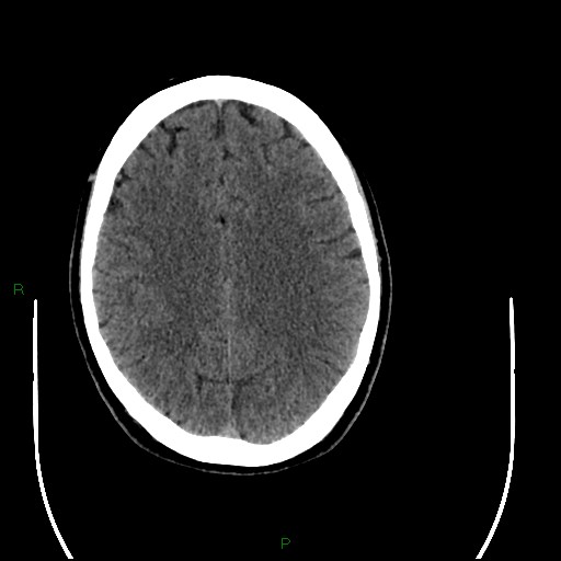 Acute posterior cerebral artery territory infarct (Radiopaedia 79329-92393 Axial non-contrast 74).jpg