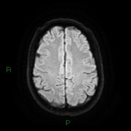 Acute posterior cerebral artery territory infarct (Radiopaedia 79329-92394 Axial DWI 21).jpg