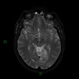 Acute posterior cerebral artery territory infarct (Radiopaedia 79329-92394 Axial DWI 41).jpg