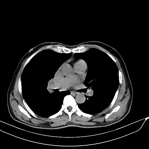 File:Acute pulmonary embolism (Radiopaedia 69510-79390 Axial non-contrast 15).jpg
