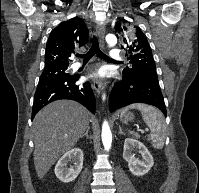 Acute pulmonary embolism with pulmonary infarcts (Radiopaedia 77688-89908 Coronal C+ CTPA 58).jpg