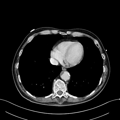 File:Acute renal infarction (Radiopaedia 59375-66736 Axial C+ portal venous phase 2).jpg