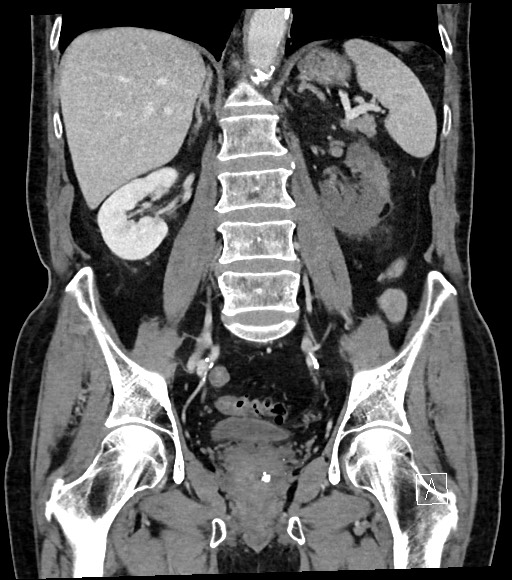 Acute renal infarction (Radiopaedia 59375-66736 Coronal C+ portal venous phase 39).jpg