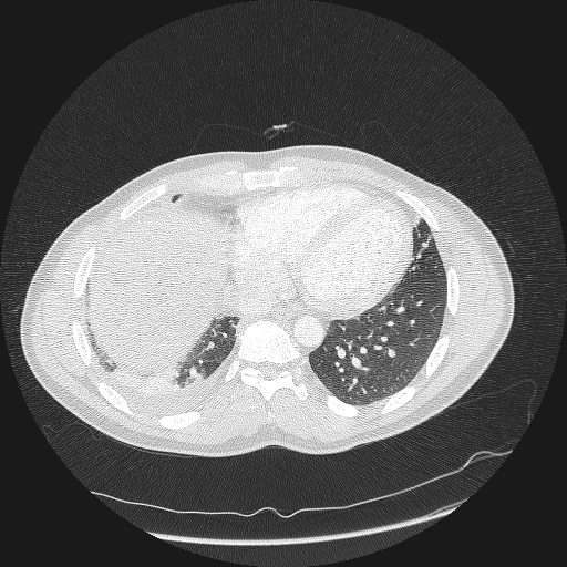 Acute segmental pulmonary emboli and pulmonary infarction (Radiopaedia 62264-70444 Axial lung window 142).jpg