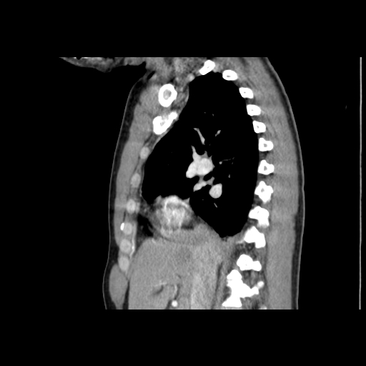 Acute segmental pulmonary emboli and pulmonary infarction (Radiopaedia 62264-70444 Sagittal C+ CTPA 27).jpg