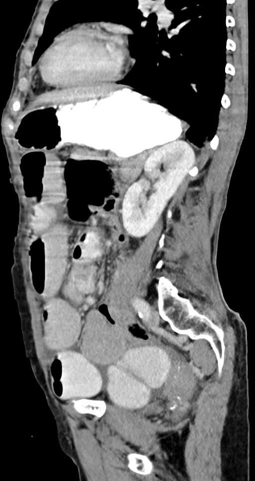 Acute small bowel (ileal) volvulus (Radiopaedia 71740-82139 Sagittal C+ portal venous phase 67).jpg