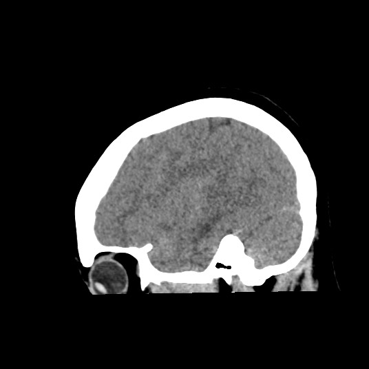Acute subarachnoid hemorrhage and accessory anterior cerebral artery (Radiopaedia 69231-79008 Sagittal non-contrast 44).jpg