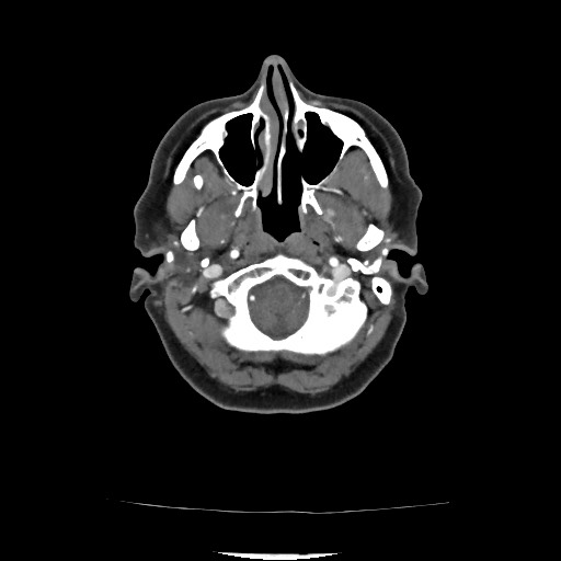 File:Acute subarachnoid hemorrhage and accessory anterior cerebral artery (Radiopaedia 69231-79009 Axial C+ arterial phase 76).jpg
