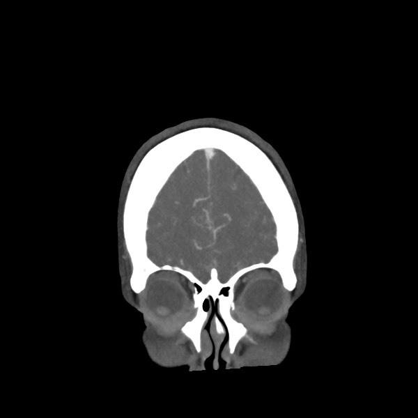 Acute subarachnoid hemorrhage and accessory anterior cerebral artery (Radiopaedia 69231-79009 Coronal C+ arterial phase 14).jpg