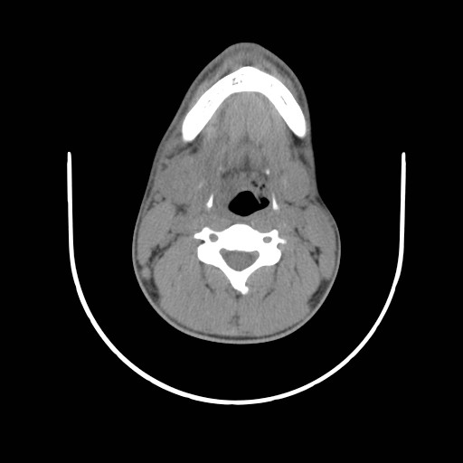 File:Acute submandibular sialadenitis secondary to ductal stone (Radiopaedia 27999-28267 Axial non-contrast 15).jpg